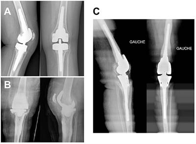 Rotating Hinge Knee Arthroplasty for Revision Prosthetic-Knee Infection: Good Functional Outcomes but a Crucial Need for Superinfection Prevention